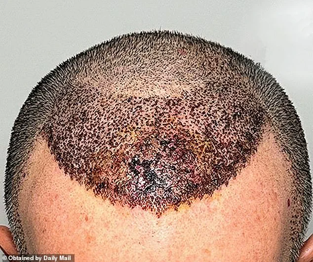 Chilling Warning: The Devastating Risks of Cheap Hair Transplants Abroad