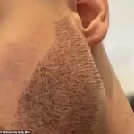 Chilling Warning: The Devastating Risks of Cheap Hair Transplants Abroad