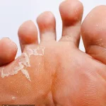 Dr. Deborah Lee Warns: Crusty Heels May Signal Contagious Fungal Infection, Risking Severe Health Complications