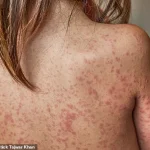 England to Introduce Free Chickenpox Vaccine for Children Under NHS Programme