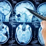 Exclusive Insights: New Brain Cancer Treatment Breakthrough Hints at Limited Access to Groundbreaking Research