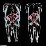 Hidden Visceral Fat in Slim Individuals Poses Significant Heart Attack Risk, Study Reveals