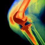 Knee Replacement Controversy: Patient's Experience vs. Surgeon's Promises