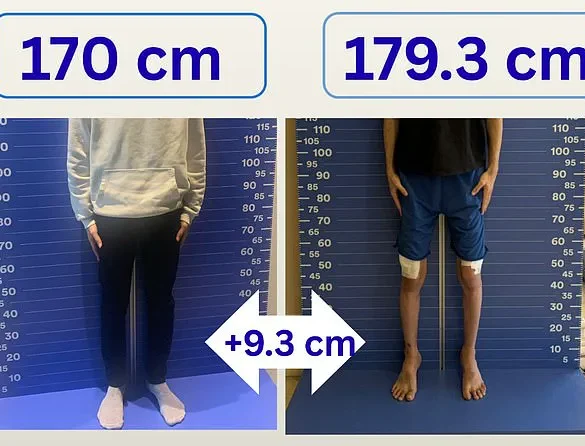 Late-Breaking: UK Men Paying for Painful Height-Boosting Surgery with Months of Recovery