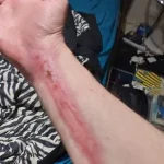 Life-Threatening Infections Follow Minor Dog Bite in Australian Man's Ordeal
