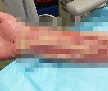 Life-Threatening Infections Follow Minor Dog Bite in Australian Man's Ordeal