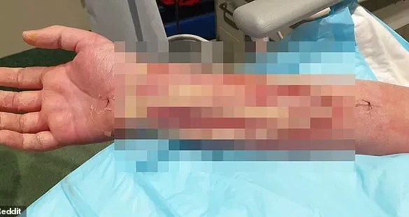 Life-Threatening Infections Follow Minor Dog Bite in Australian Man's Ordeal