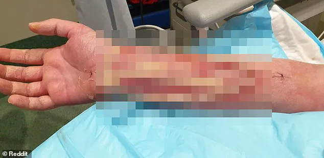 Life-Threatening Infections Follow Minor Dog Bite in Australian Man's Ordeal