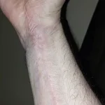 Life-Threatening Infections Follow Minor Dog Bite in Australian Man's Ordeal