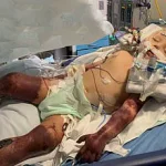 Life-Threatening Infections Follow Minor Dog Bite in Australian Man's Ordeal