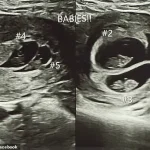 Medical Marvel: The Unprecedented Journey of Theresa Troia and Her Quintuplets