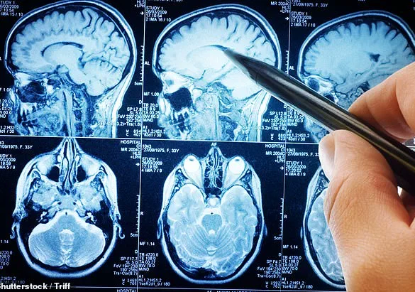 New Study Alarms: Traumatic Brain Injuries Linked to Higher Risk of Malignant Brain Tumors