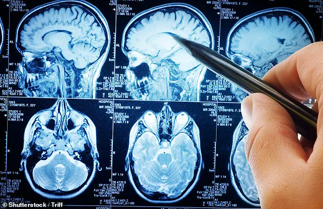 New Study Alarms: Traumatic Brain Injuries Linked to Higher Risk of Malignant Brain Tumors