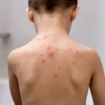 NHS Embarks on Groundbreaking Shift in Childhood Immunisation: Chickenpox Vaccine to Be Introduced for Babies, Supported by Public Health Experts