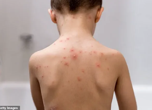NHS Embarks on Groundbreaking Shift in Childhood Immunisation: Chickenpox Vaccine to Be Introduced for Babies, Supported by Public Health Experts
