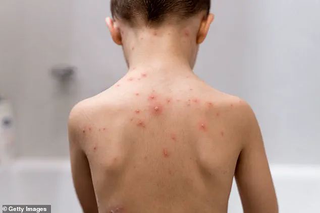NHS Embarks on Groundbreaking Shift in Childhood Immunisation: Chickenpox Vaccine to Be Introduced for Babies, Supported by Public Health Experts
