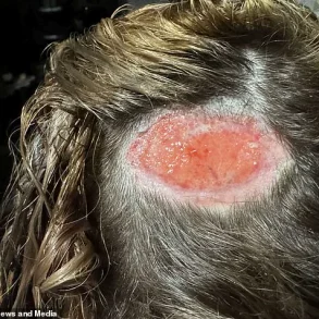 North Carolina teen's hair dye attempt results in scalp burn, leaving giant hole