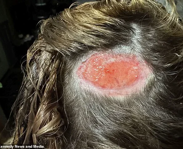 North Carolina teen's hair dye attempt results in scalp burn, leaving giant hole