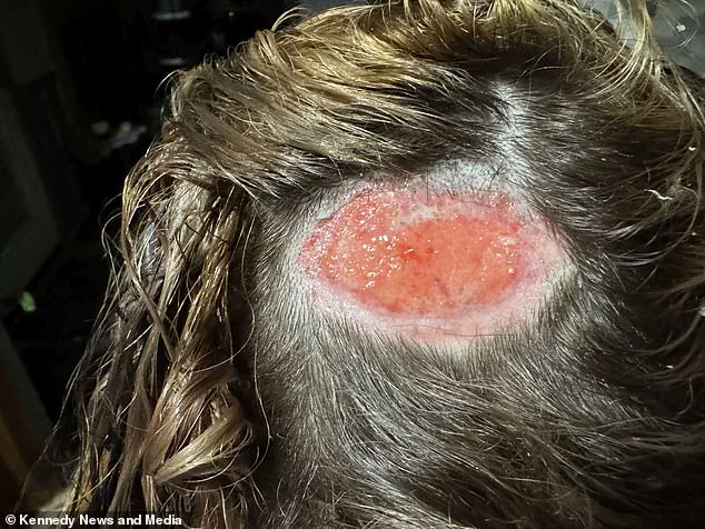 North Carolina teen's hair dye attempt results in scalp burn, leaving giant hole