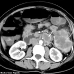 Postpartum Symptoms Mask Terminal Colon Cancer Diagnosis, Shocking Medical Community