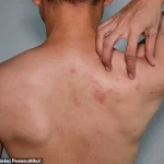 Study Suggests Shingles Vaccine May Cut Heart Attack and Stroke Risk by 18%, Raising Questions About Public Health Strategies