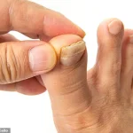 The Hidden Crisis of Toenail Complications: A Podiatrist’s Perspective on Preventable Suffering