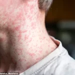 Urgent Call to Vaccinate Children During Summer Holidays as Measles Cases Surge, UKHSA Warns of Potential Public Health Crisis