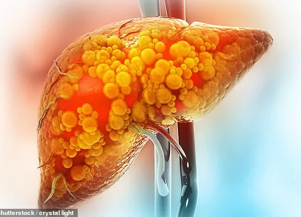 Urgent Warning: Active Lifestyle Doesn't Prevent Liver Disease, as 36-Year-Old Finance Pro Discovers