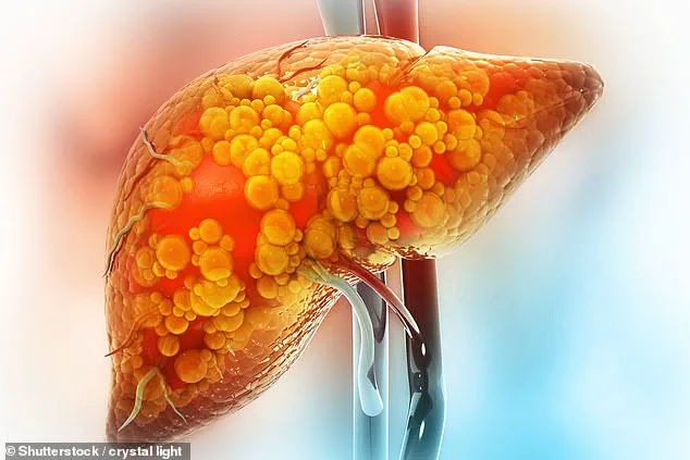 Urgent Warning: Active Lifestyle Doesn't Prevent Liver Disease, as 36-Year-Old Finance Pro Discovers
