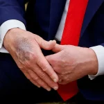 Visible Bruise on President Trump's Hands Sparks New Speculation About His Health
