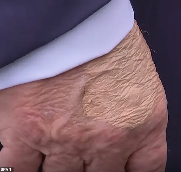 Visible Bruise on President Trump's Hands Sparks New Speculation About His Health