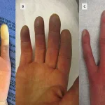Breakthrough in Raynaud’s Disease Treatment: Minimally Invasive Surgery from Chinese Hospital Offers Hope for 30 Million Americans