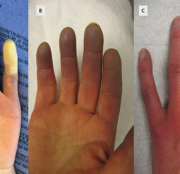 Breakthrough in Raynaud’s Disease Treatment: Minimally Invasive Surgery from Chinese Hospital Offers Hope for 30 Million Americans