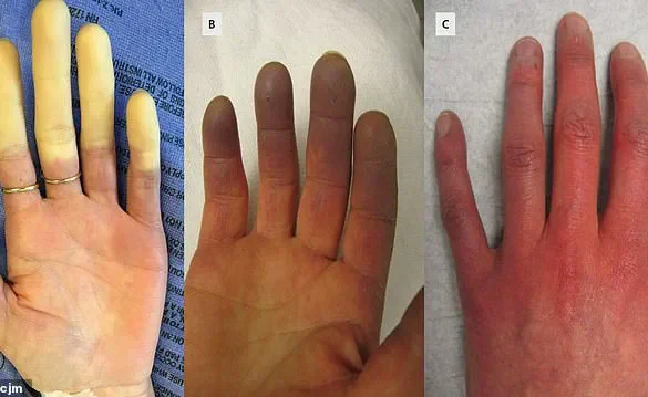Breakthrough in Raynaud’s Disease Treatment: Minimally Invasive Surgery from Chinese Hospital Offers Hope for 30 Million Americans