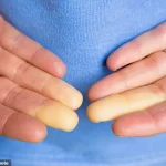 Breakthrough in Raynaud’s Disease Treatment: Minimally Invasive Surgery from Chinese Hospital Offers Hope for 30 Million Americans