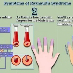 Breakthrough in Raynaud’s Disease Treatment: Minimally Invasive Surgery from Chinese Hospital Offers Hope for 30 Million Americans