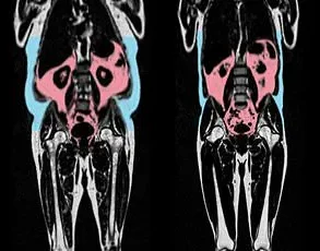 Danish Study Finds Underweight Linked to Higher Mortality Risk Than Overweight, Prompting Reevaluation of Health Guidelines