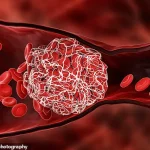Deep Vein Thrombosis Risk Rises with Prolonged Sitting, Experts Warn