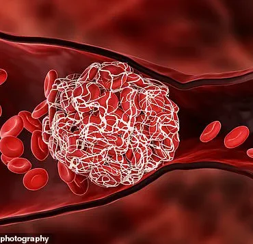 Deep Vein Thrombosis Risk Rises with Prolonged Sitting, Experts Warn