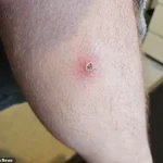 Exclusive: Hidden Dangers of a Noble False Widow Spider Bite Revealed Through a Window Cleaner's Ordeal