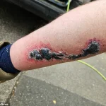 Exclusive: Hidden Dangers of a Noble False Widow Spider Bite Revealed Through a Window Cleaner's Ordeal