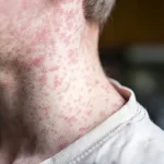 Measles Outbreak in Utah Highlights Need for Strengthened Vaccination Regulations to Protect Public Health
