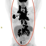 Miraculous Survival: Rare Cancer and Hospital Superbug Alter Fate of Young Mother