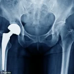 Urgent Warning: Thousands of British Patients Face Health Risks Due to Hip Implant Malfunction, Says MHRA