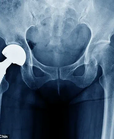 Urgent Warning: Thousands of British Patients Face Health Risks Due to Hip Implant Malfunction, Says MHRA