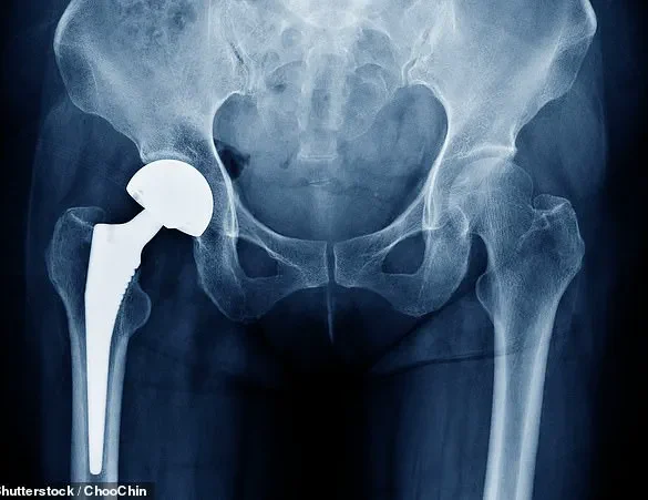 Urgent Warning: Thousands of British Patients Face Health Risks Due to Hip Implant Malfunction, Says MHRA