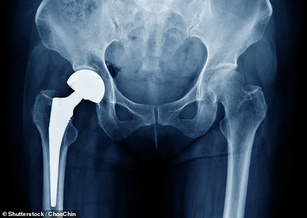 Urgent Warning: Thousands of British Patients Face Health Risks Due to Hip Implant Malfunction, Says MHRA